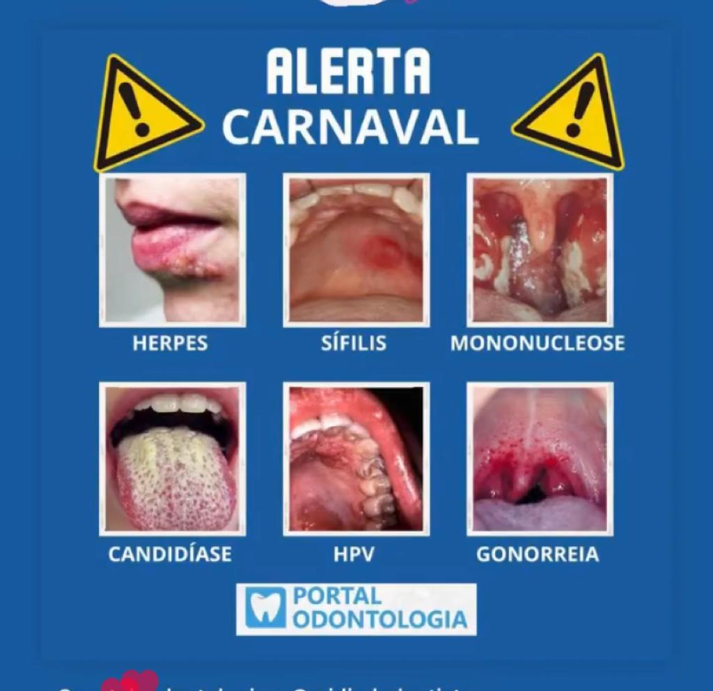 O que é a Mononucleose (doença do beijo)?